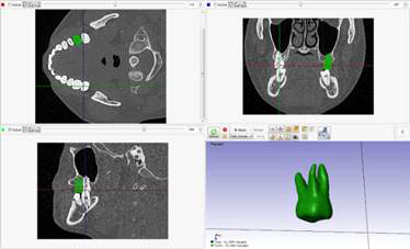 Construction of one tooth geometry using Scan-IP
