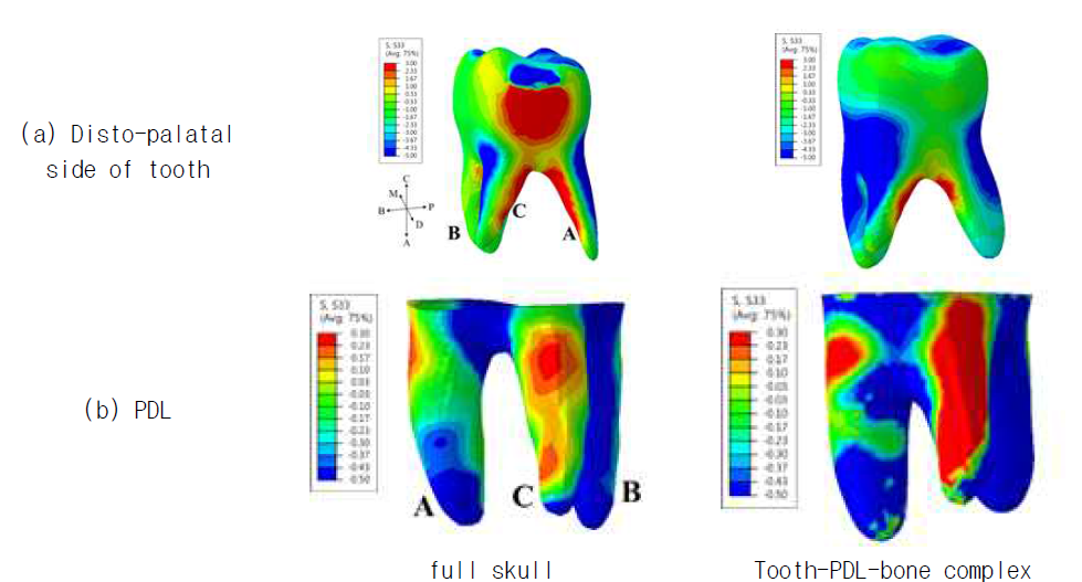 The z-directional stress distributions of tooth #16 and PDL #16 in full skull model and tooth-PDL bone complex model