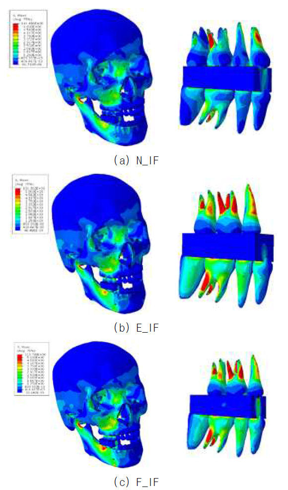 Stress distributions of the skull models including food (Left: full skull / Right: teeth and food)