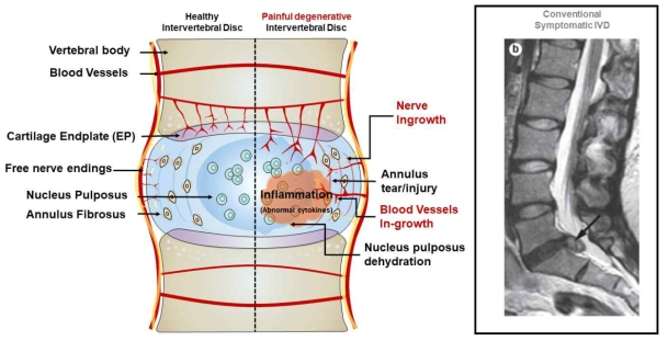 추간판 탈출에 의한 신경근 압박 MRI 이미지 및 본 제안 연구과제 병리학적 메커니즘 모식도