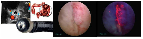 Endoscope with fluorescence imaging and utilization for cololectal cancer diagnosis