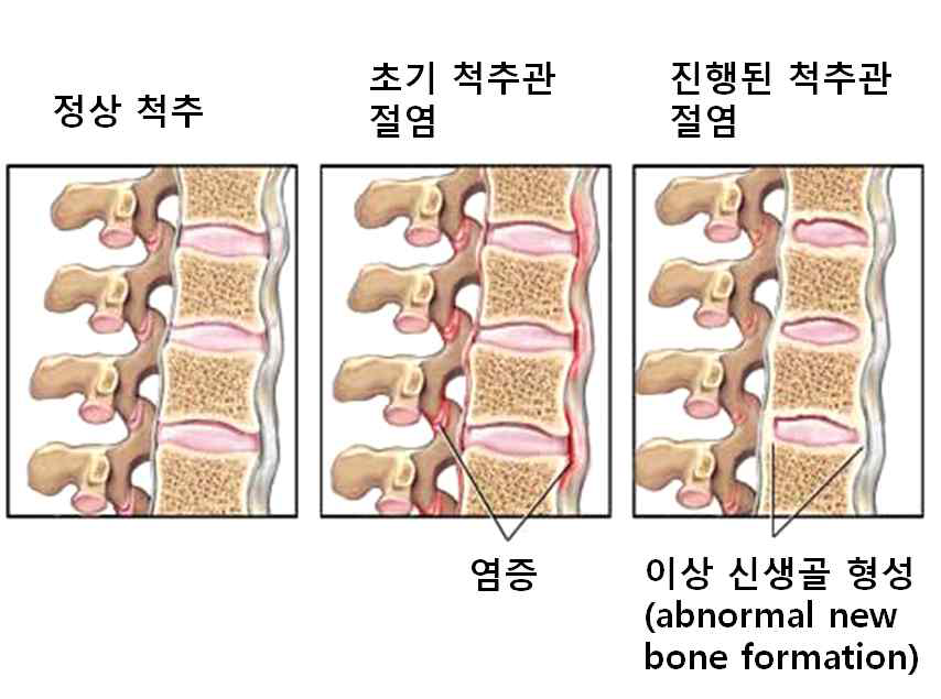 척추관절염에서의 이상 신생골 형성. 척추관절염은 초기에 염증이 발생하고 이후 진행하면 이상 신생골 형성이 발생한다