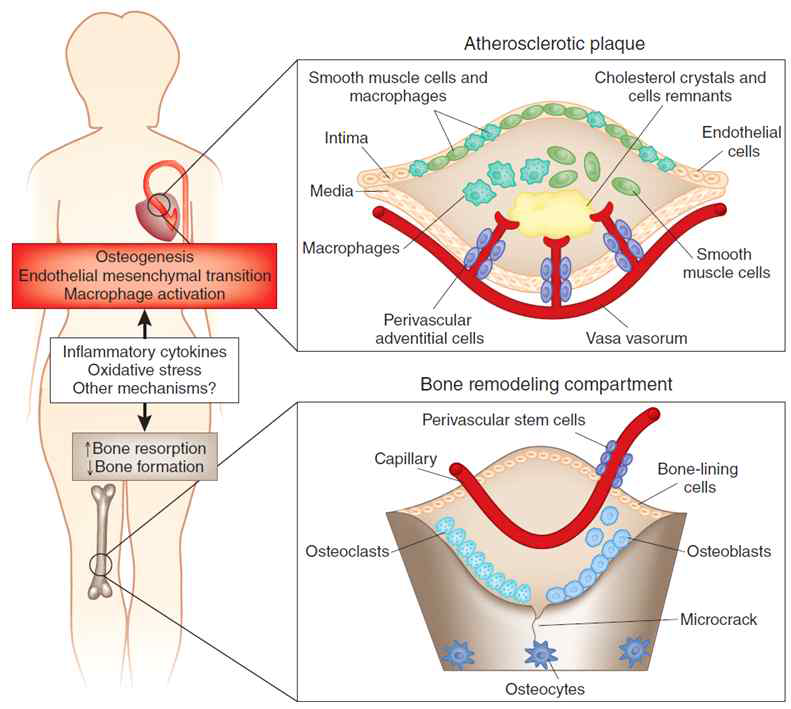 Bone remodeling과 atherosclerotic plaque와의 연관성