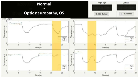 정상인과 좌안의 시신경병증 환자의 동공반응 차이를 보여주고 있는 프로그램 화면