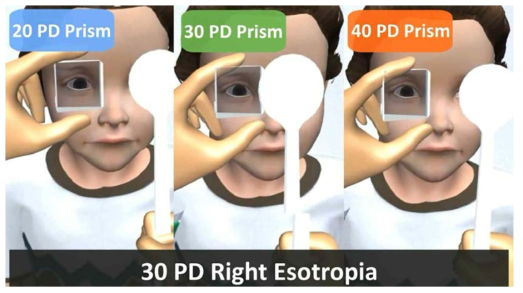 가상의 우안 내사시 환자를 가상의 프리즘과 가리개로 30 PD의 우안 내사시를 진단하는 프로그램 화면