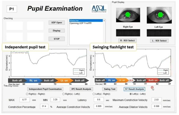 가상현실기기를 이용하여 양안을 동시에 동공의 수축 및 확장과 그 속도를 측정하고 그래프와 수치로 표시하고 있는 프로그램 화면