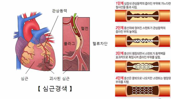 심근경색과 재관류 치료법 모식도