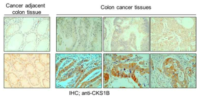 대장암에서 CKS1B 발현; IHC