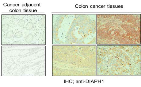 대장암조직에서 증가되어있는 DIAPH1