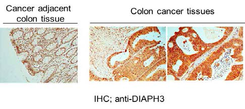 대장암조직에서 증가되어있는 DIAPH3