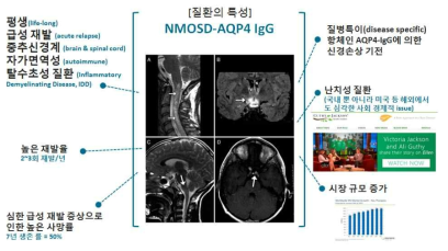 항아쿠아포린4면역 글로불린 시신경척수염 스펙트럼 질환 (Neuromyelitis optica spectrum disorder with AQP4-IgG)의 특성