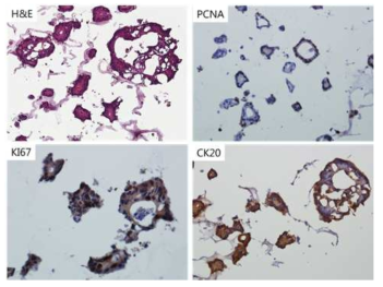 환자유래세포 122T의 H&E staining 과 Immunohistochemistry 사진