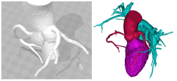CFD 해석을 위한 대동맥-관상동맥 3D volume rendering image