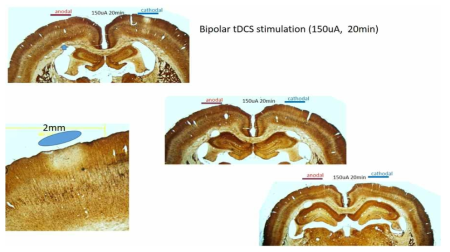 직경 2mm 원형 전극으로 양측 대뇌피질을 동시에 경두개직류자극 한 경우에 음극직류작그에 의해 대뇌피질의 thallium 흡수의 현저한 감소