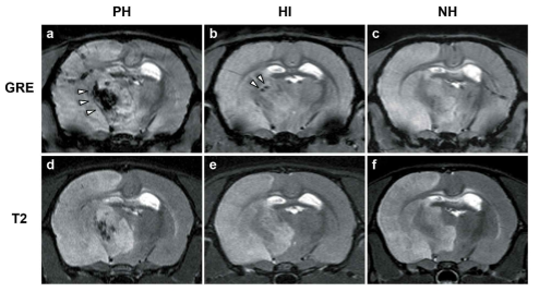 대표적인 MRI 영상. 윗줄: Gradient-recalled echo (GRE)-MRI (a) 뇌실질내 출혈(PH), (b) 출혈성 경색(HI), (c) 무출혈(NH). 아랫줄: T2-weighted MRI (d) 뇌실질내 출혈, (e) 출혈성 경색, (f) 무출혈