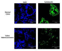 대장암 환자 조직 슬라이드에서 정상대장 조직과 대장암 조직에서 cytokeratin 염색