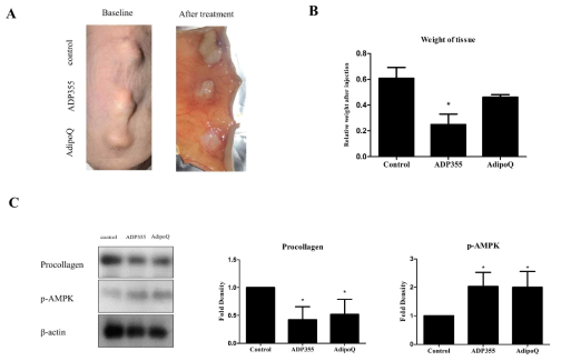 Macrographic examination of xenotransplanted tissue on the back of athymic nude mice before and after treatment (A). Weinght of xenografted keloid tissues after intralesional injection of ADP355 and AdipoQ. The weight of the tissues was normalized to the baseline weight, and the weight of adiponectin-treated tissue was compared to that of control. ADP355-treated lesions showed a significant weight reduction(B, * p 0.05). Procollagen protein expression was significantly reduced while p-AMPK expression increased following treatment with ADP355 and AdipoQ(B, C, * p 0.05). The data are expressed as mean SD. Representative data are shown from three independent experiments