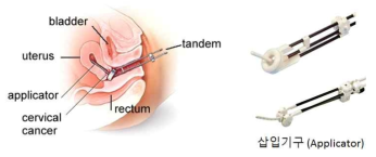 자궁경부암 치료를 위한 삽입기구(Applicator)