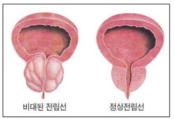 정상 전립선과 비대된 전립선