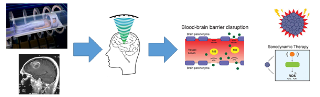 자기공명영상(MRI)-유도하 초음파를 이용한 혈뇌 장벽의 음파감각제 투과 향상 및 초음파역학치료법의 병행치료 연구