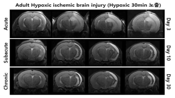 허혈성 뇌 손상 동물모델 시기에 따른 뇌 손상정도 MRI 확인