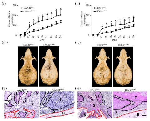 Axin2 및 Snail 발현이 구강암 뼈 침윤에 미치는 영향