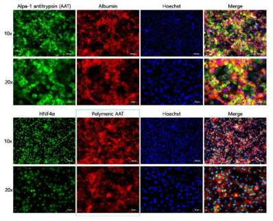 알파 1 항 트립신 결핍증 환자 hiPS(DNiPSC 2522)로부터 hepatocyte like cells로의 분화