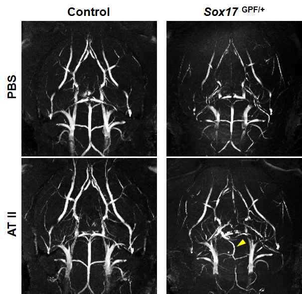 Sox17 결핍 쥐에서의 뇌동맥류 질환 형성 확인
