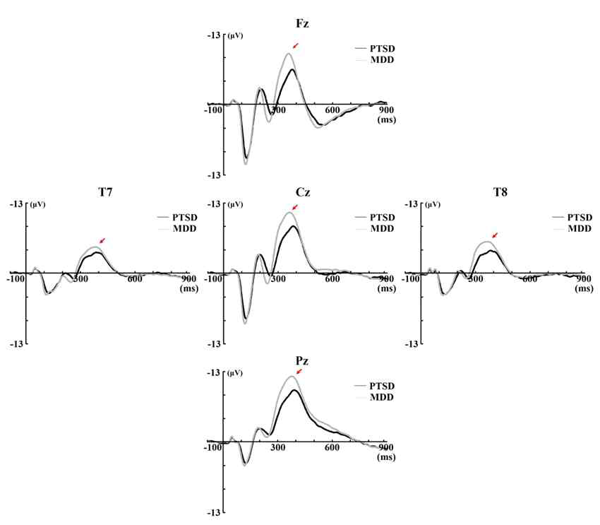 우울장애와 외상 후 스트레스 장애 환자군의 ERP 성분의 grand average