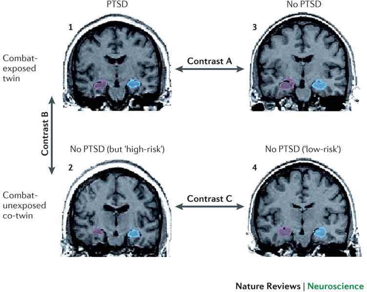 PTSD환자와 PTSD 고위험 집단의 감소된 해마 볼륨