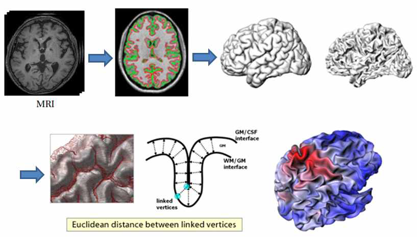 MRI 측정 및 cortical thickness를 구하는 과정