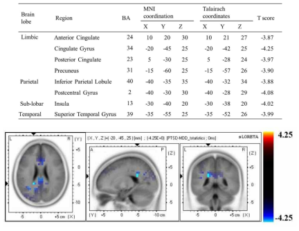 PTSD 환자군의 감소된 P300 영역