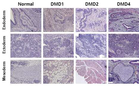 정상인 및 DMD 환자 유래 iPSC 의 teratoma 형성