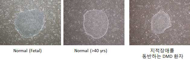 정상인 및 지적장애를 동반하는 DMD 환자의 혈액 단핵세포로부터 iPSC 형성