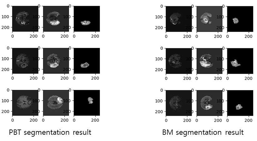 BRATS2015학습 후 SNUH 원발성뇌암, 뇌전이암 환자의 뇌종양 추출 결과. 왼쪽부터 T1ce, FLAIR이미지, 추출된 종양
