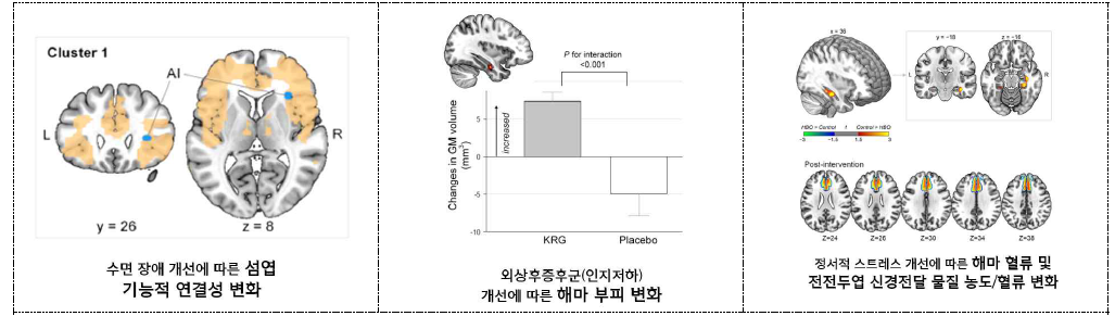 외상후증후군 증상 개선과 외상후증후군 후보 뇌영상 지표 변화 관련성 분석