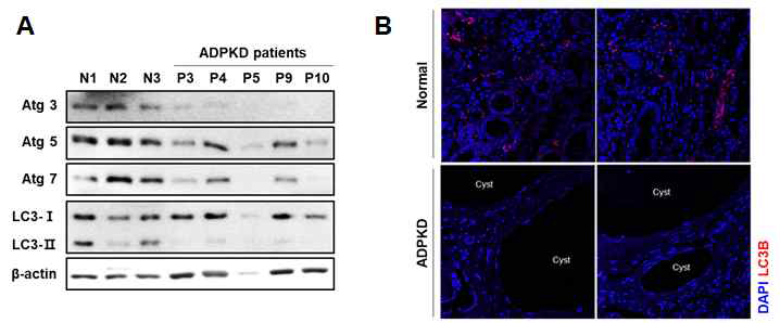 PKD 환자 신장에서 basal autophagy 수준 스크리닝