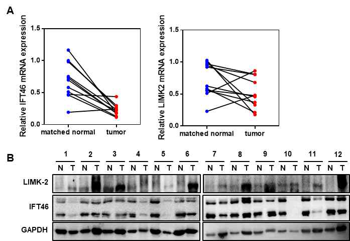 Matched normal 대비 신장암 환자의 tumor 조직에서 IFT46, LIMK2 mRNA 및 단백질 발현 검증