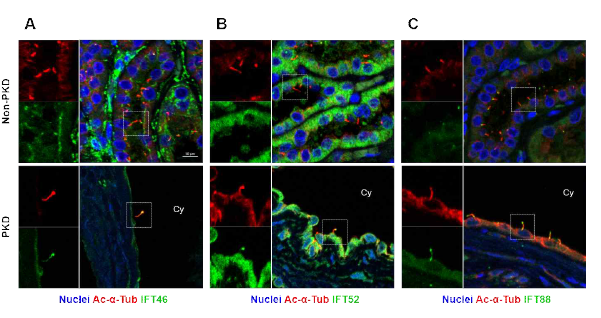 다낭신 환자의 신장 조직의 일차섬모에서 IFT 단백질의 발현 검증