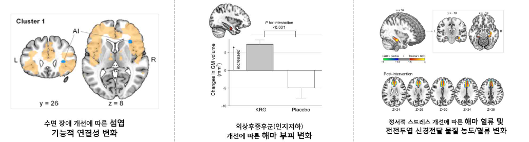 외상후증후군 증상 개선과 외상후증후군 후보 뇌영상 지표 변화 관련성 분석