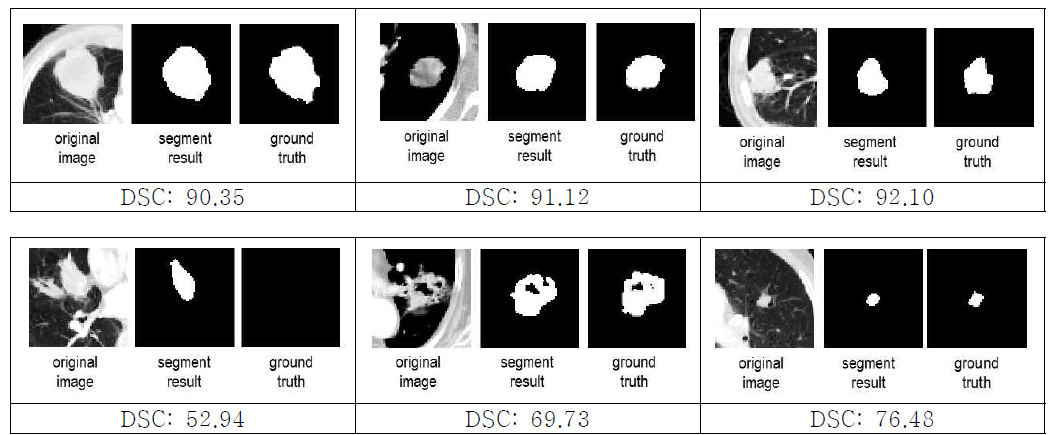 제안된 방법을 이용한 폐 결절/종양 분할 결과