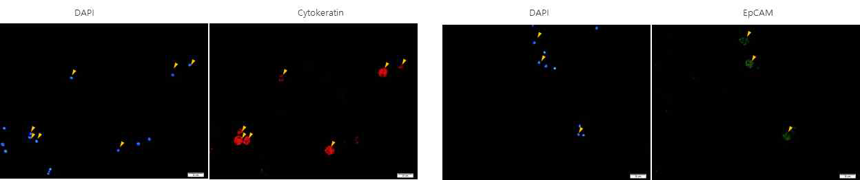 폐암환자 혈액의 Immunocytostain 결과 –2 (DAPI, Cytokeratin, EpCAM)