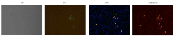 NCI-H526 cell line를 spike시킨 폐암환자 혈액에서의 Immunocytostain 결과 -2 (DAPI, Cytokeratin, EpCAM)