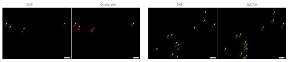 폐암환자 혈액의 Immunocytostain 결과 –1 (DAPI, Cytokeratin, EpCAM)