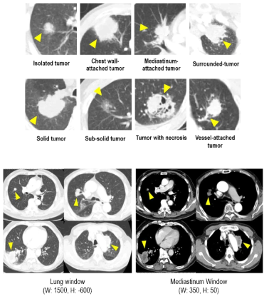 흉부 CT 영상에서 폐종양의 다양한 특성(상단)과 윈도우 설정에 따른 폐종양 경계 구분 차이(하단)