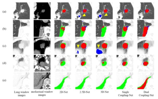 2D-Net, 2.5D-Net, 3D-Net, Single Coupling-Net, Dual Coupling-Net의 각 type 별 폐암 분할 결과 비교 (a) isolated tumor (type 1), (b) chest wall-attached tumor (type 2), (c) mediastinum-attached tumor (type 3), (d) surro unded-tumor by chest wall at the apex of lung (type 4), (e) surrounded-tumor by liver and chest wall at the base of lung (type 4)