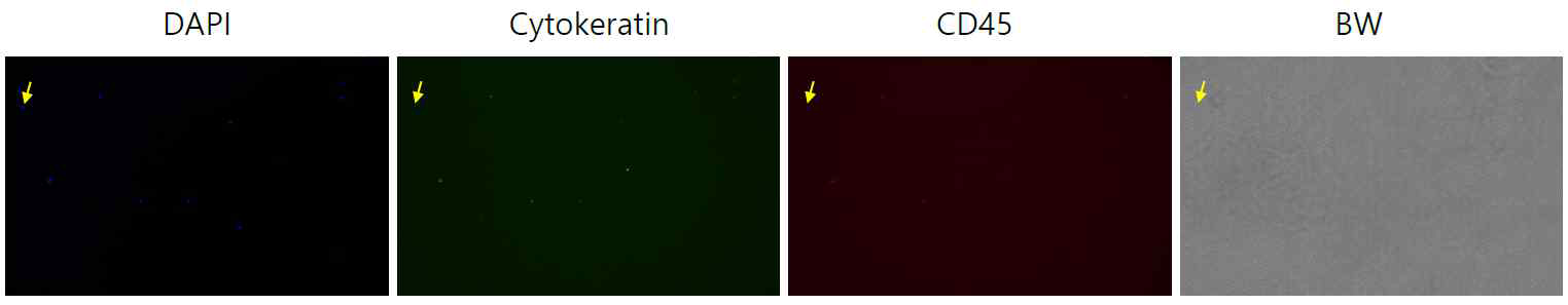 폐암 환자 혈액세포의 Immunocytostain 결과 –1 (DAPI, Cytokeratin, CD45, BF)