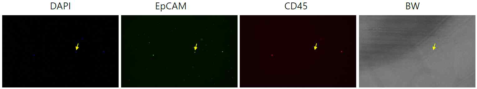 폐암 환자 혈액세포의 Immunocytostain 결과 –2 (DAPI, EpCAM, CD45, BF)