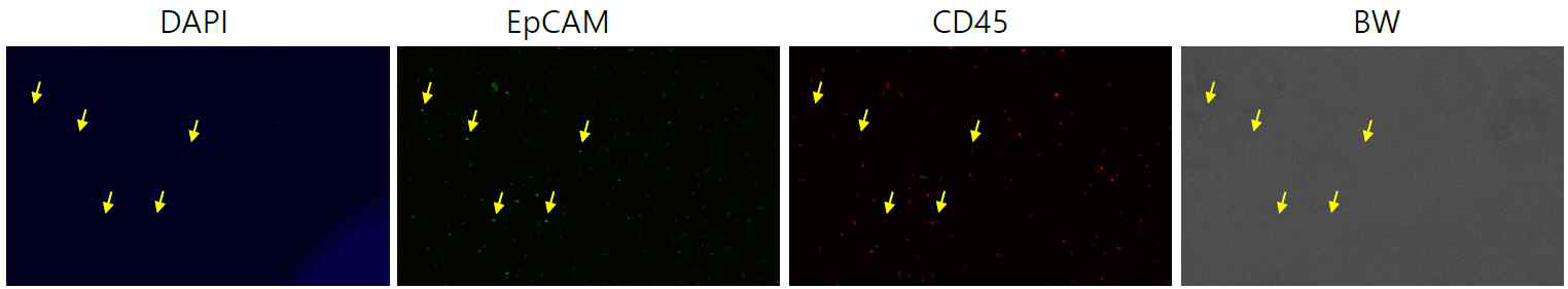 폐암 환자 혈액세포의 Immunocytostain 결과 –6 (DAPI, EpCAM, CD45, BF)