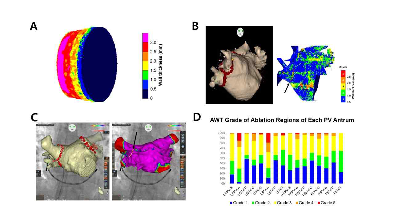 3차원 심방벽 두께 모델 구현 및 임상 적용의 예시